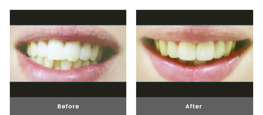 Invisalign before after