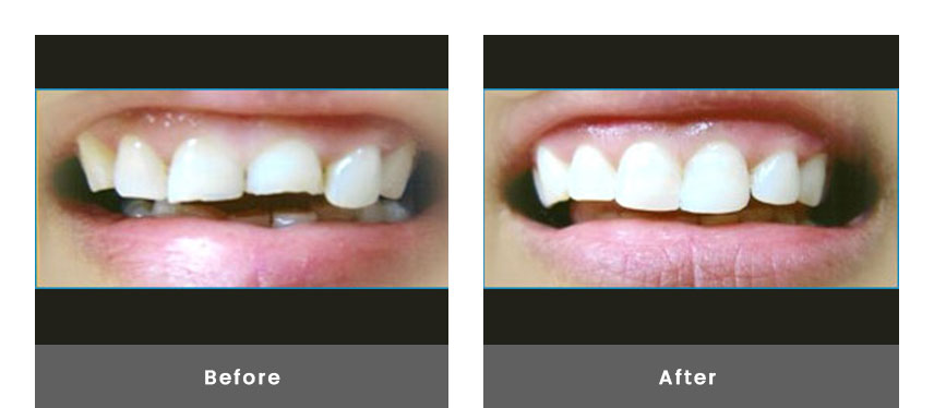 Anterior Bonding before & after