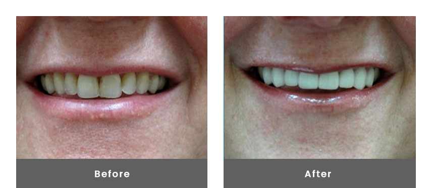 Anterior Crowns and Veneers before after