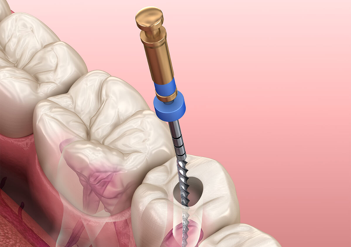 Root Canal Treatment in Aurora IL Area