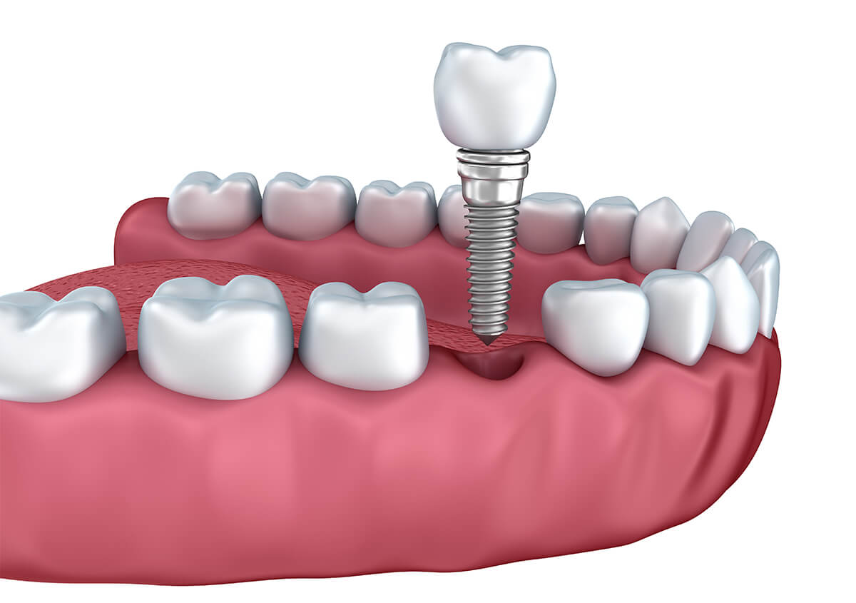 Teeth Implants in Aurora IL Area