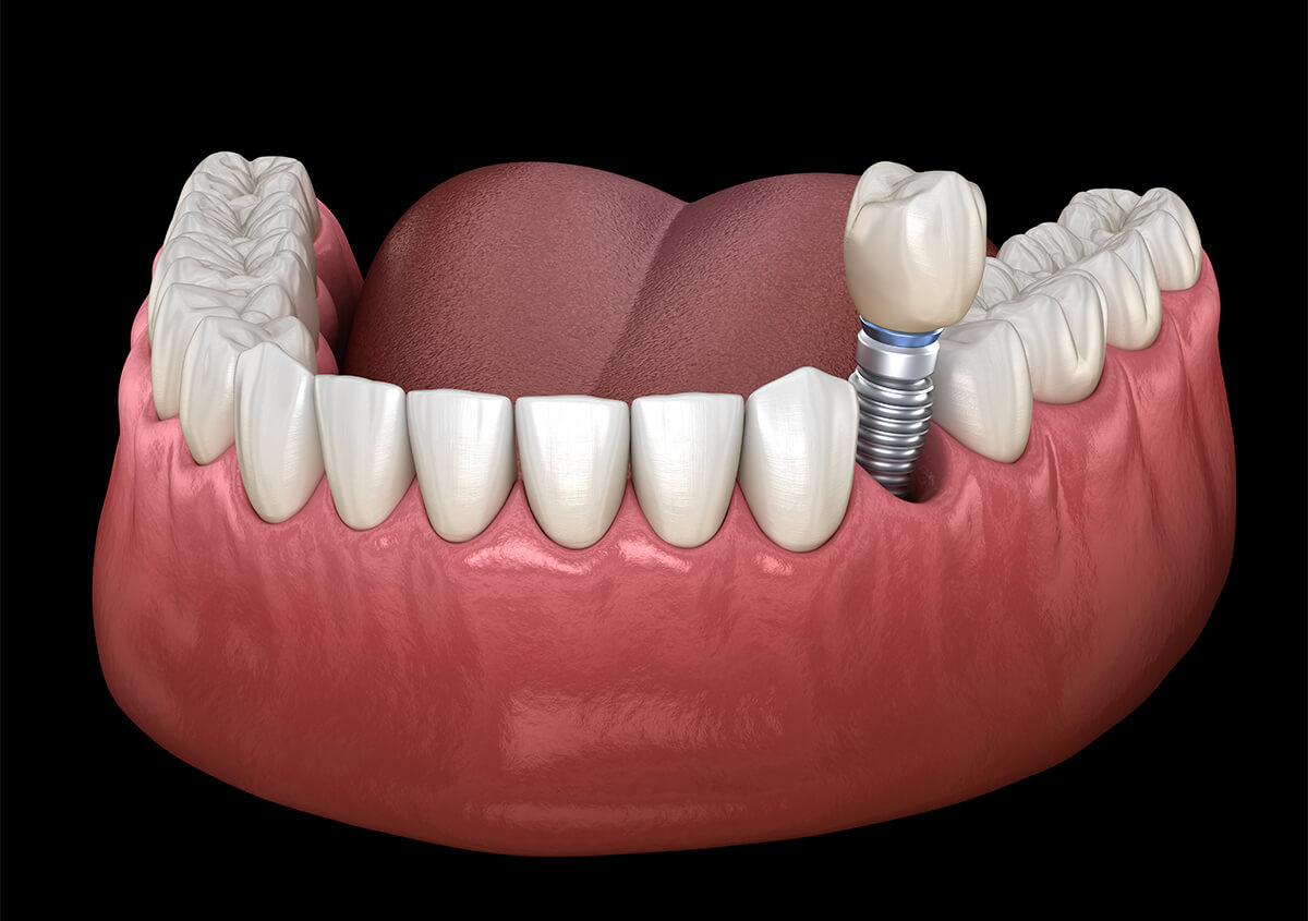 Getting a Tooth Implant in Aurora IL Area