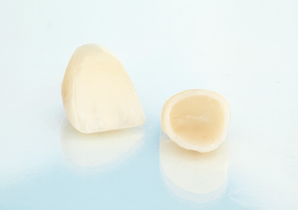 Dental crowns without a root canal
