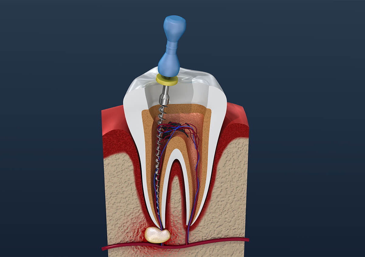 Is Endodontics Same as Root Canal in Aurora IL Area